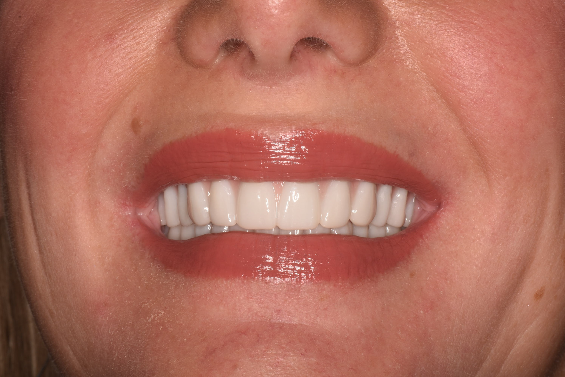 After treatment: full upper and lower implant-supported bridges with an even, natural-looking smile