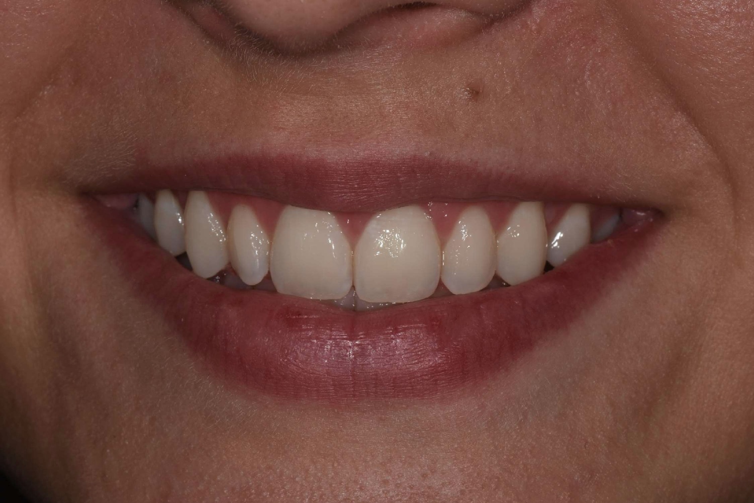 After esthetic crown lengthening: front teeth with natural proportions and an even gum line
