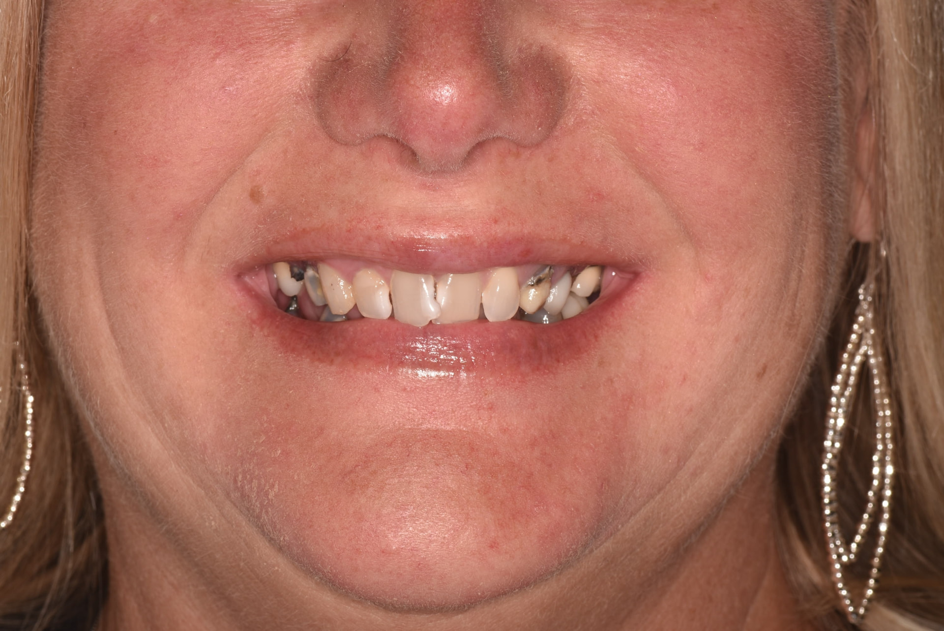 Before treatment: worn and broken-down upper and lower teeth with failing restorations