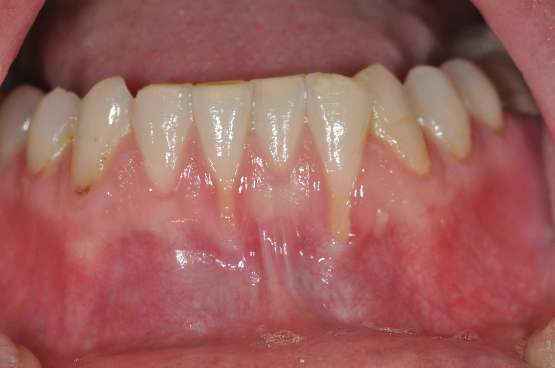 Before treatment: significant gum recession exposing the roots of the lower front teeth