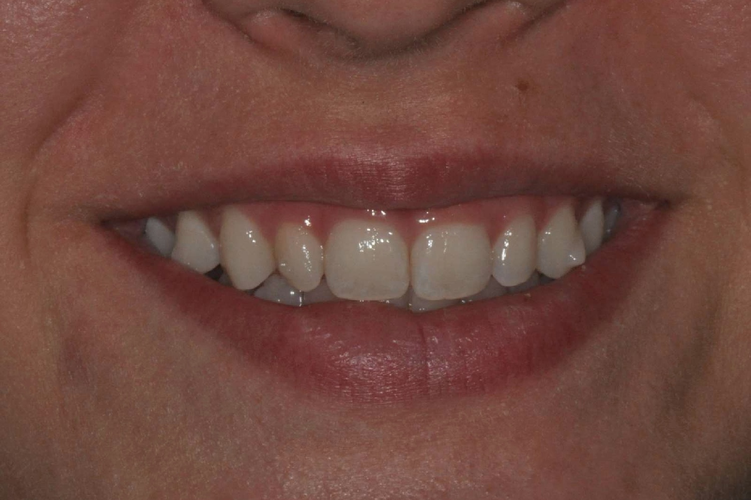 Before treatment: smile showing short, wide-looking front teeth with excess gum display