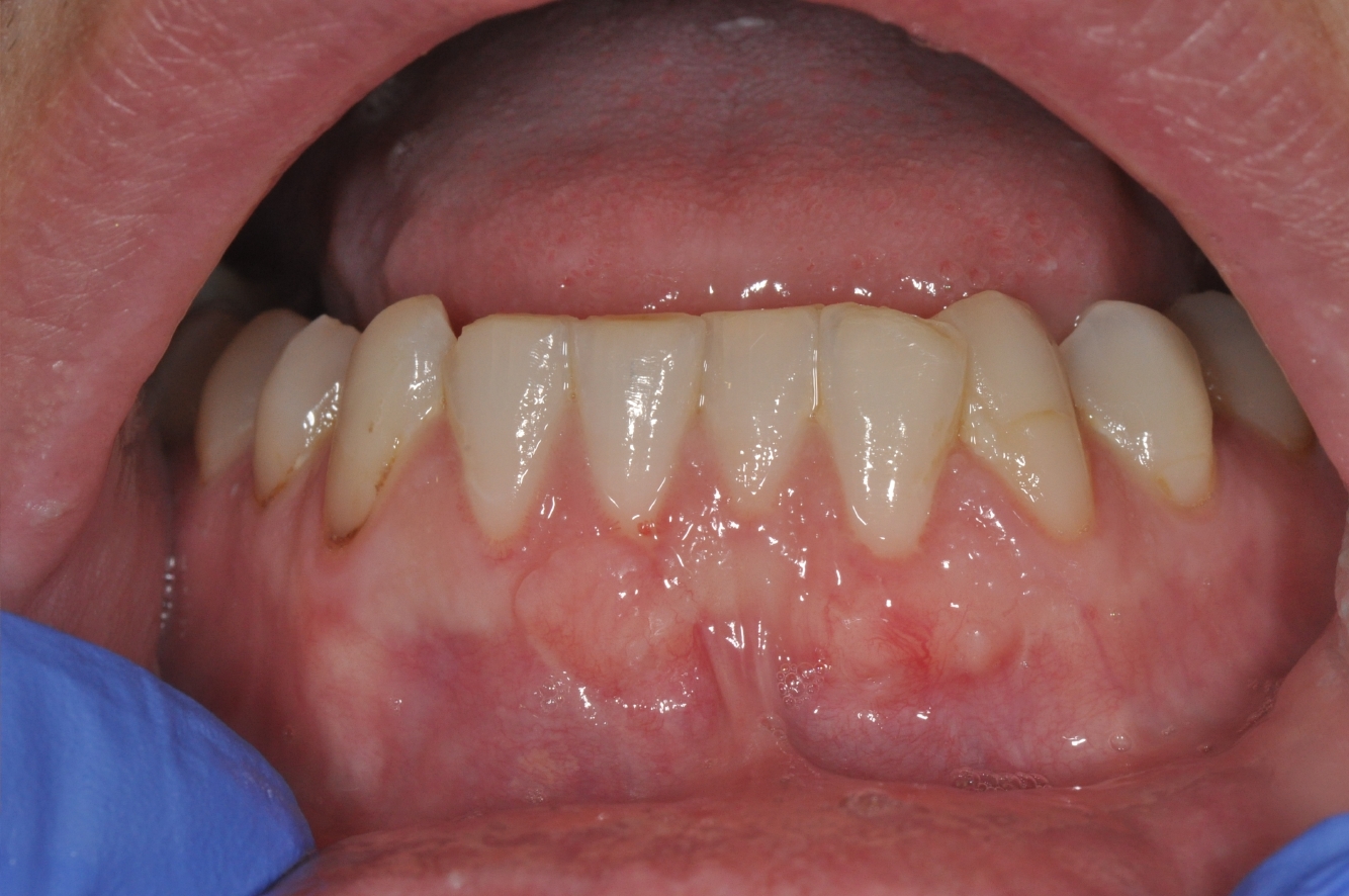 After connective tissue grafting: gum tissue covering the previously exposed roots of the lower front teeth