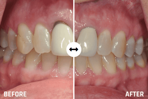 Periodontal Disease in Tulsa