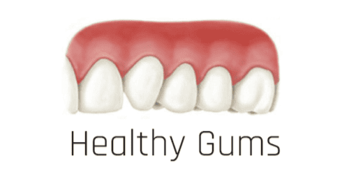 Gum Recession