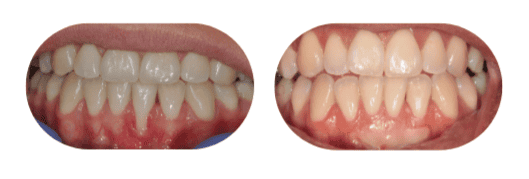 Gum Recession