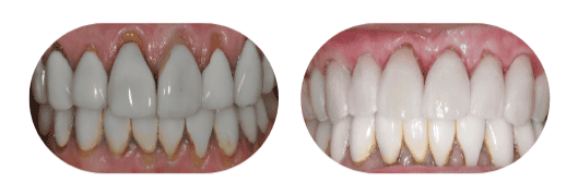 Gum Recession Tulsa