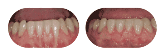 Gum Recession Tulsa