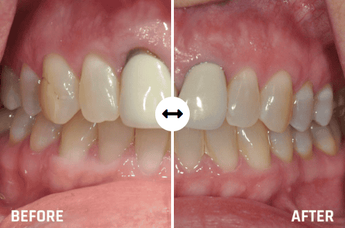 Periodontal Disease in Tulsa