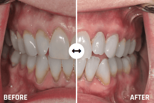 Dental Implants in Tulsa