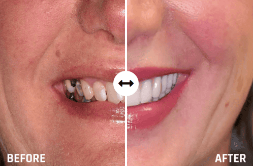 Dental Implants in Tulsa