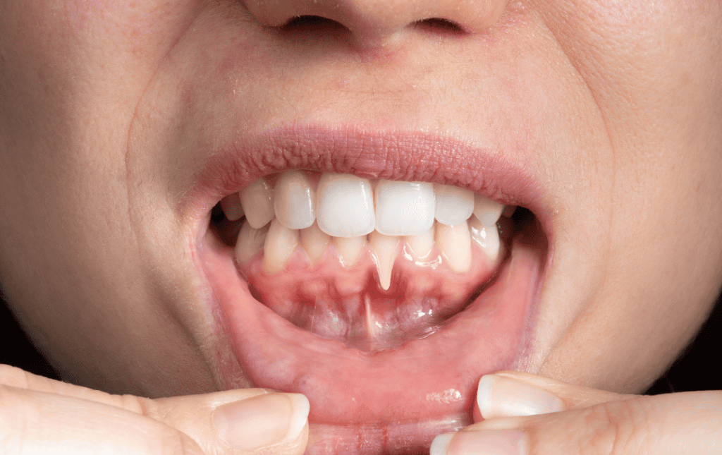 Receding Gums