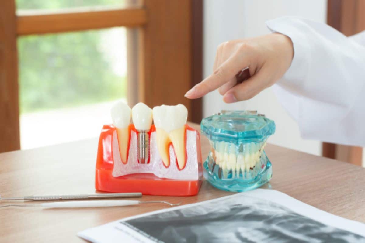 Why a Periodontist for Implants