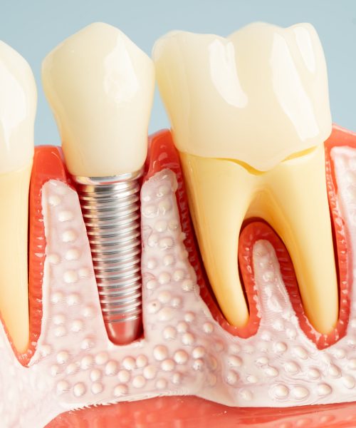 Dental implant, artificial tooth roots into jaw, root canal of dental treatment, gum disease, teeth model for dentist studying about dentistry.